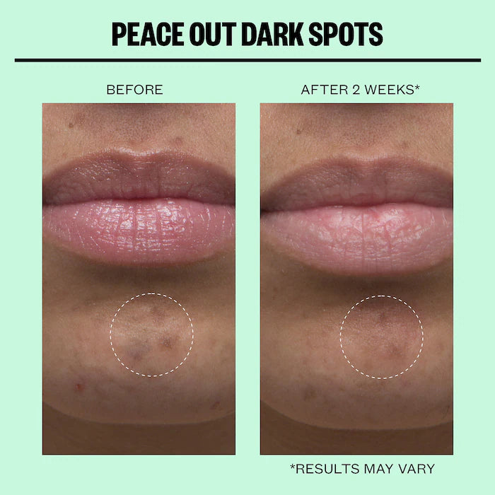 Peace Out | Microneedling Dark Spot Brightening Dots