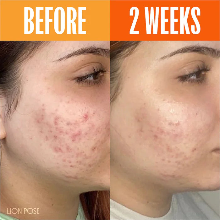 Lion Pose | UNSPOTTED 4X Dark Spot + Hyperpigmentation AHA Serum