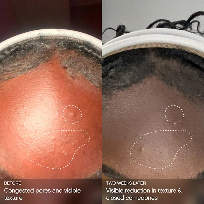 Topicals | Clearly Clarifying & Calming Mist For Acne-Prone Skin