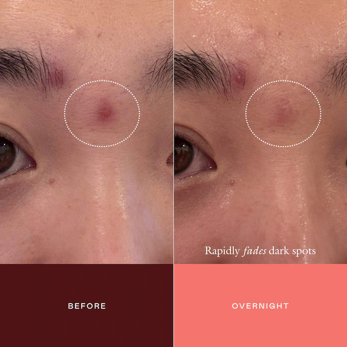 EADEM | The Mark Advanced Targeted Dark Spot Concentrate with 5% Tranexamic Acid, 1% Alpha Arbutin & 1% Kojic Acid for Hyperpigmentation, Acne Marks & Age Spots