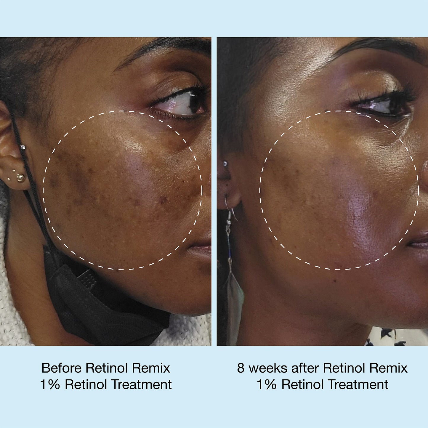 iNNBEAUTY PROJECT | Retinol Remix 1% Retinol Treatment With Peptide & Tranexamic Acid