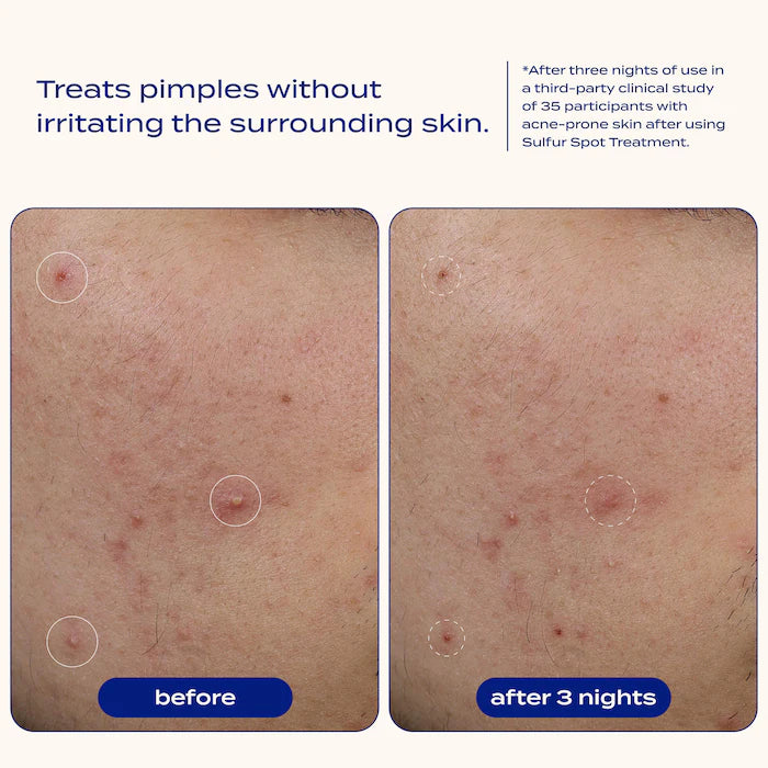 banu | Sulfur Spot Treatment for Acne and Blemishes