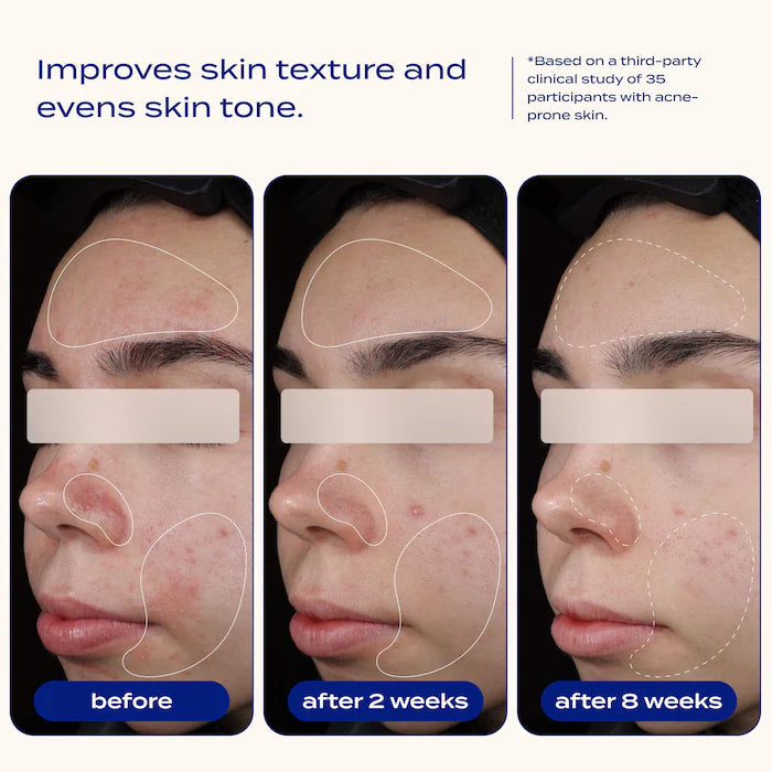 banu | AHA + BHA Blemish Clearing and Exfoliating Serum with 2% Salicylic Acid