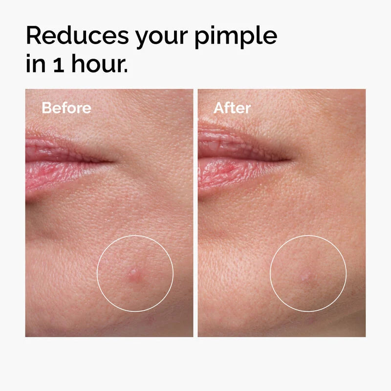The Ordinary | Sulfur 10% Powder-to-Cream Concentrate Acne Spot Treatment