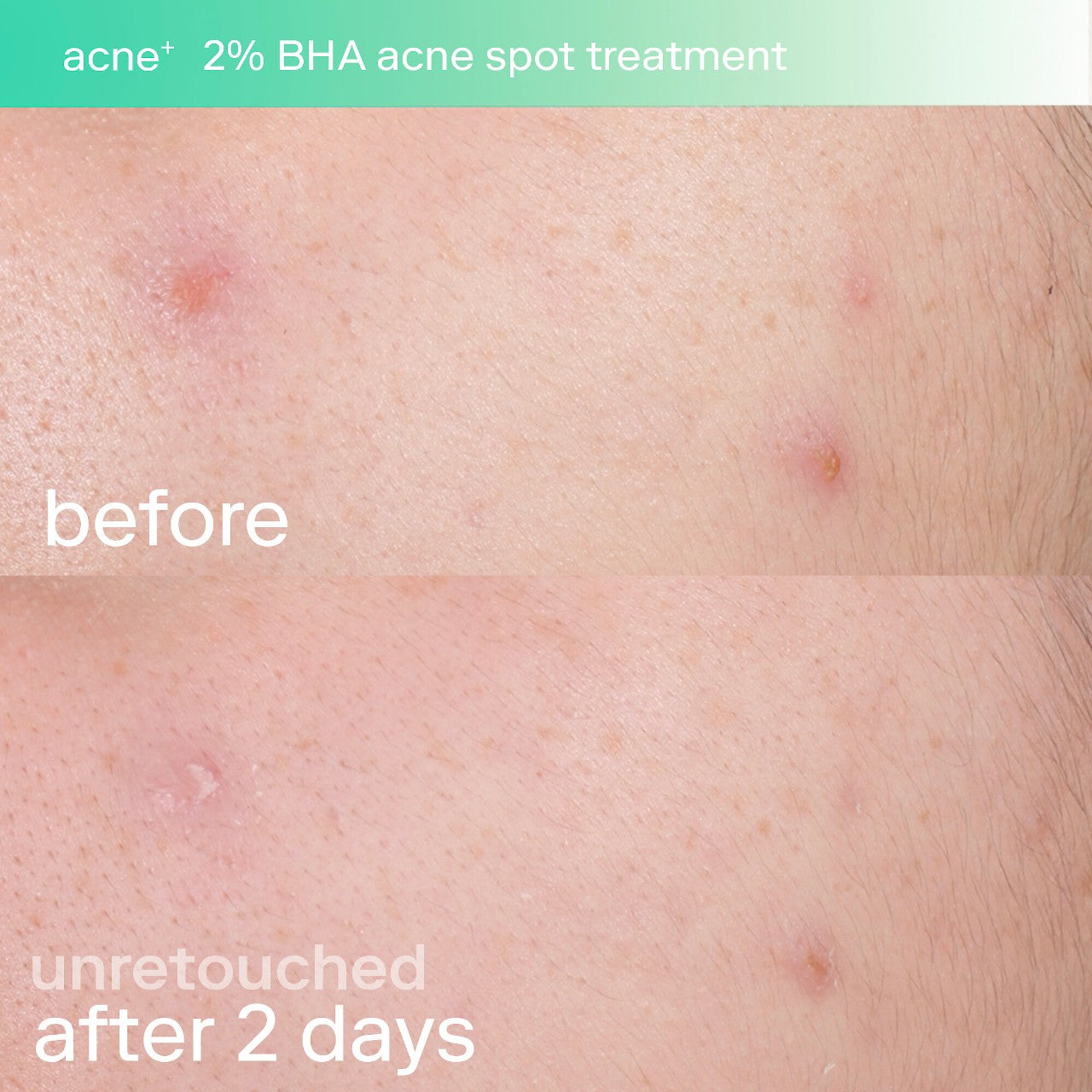 SKINFIX | Acne+ 2% BHA and Azelaic Acid Acne Spot Treatment