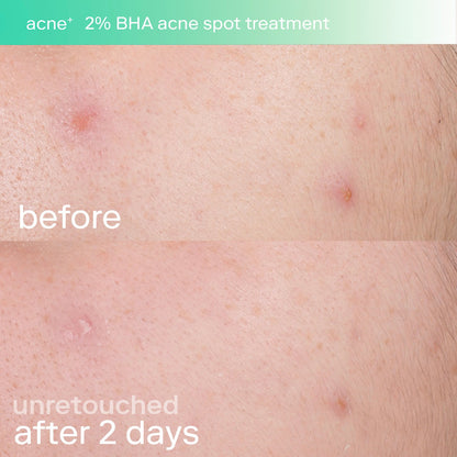 SKINFIX | Acne+ 2% BHA and Azelaic Acid Acne Spot Treatment