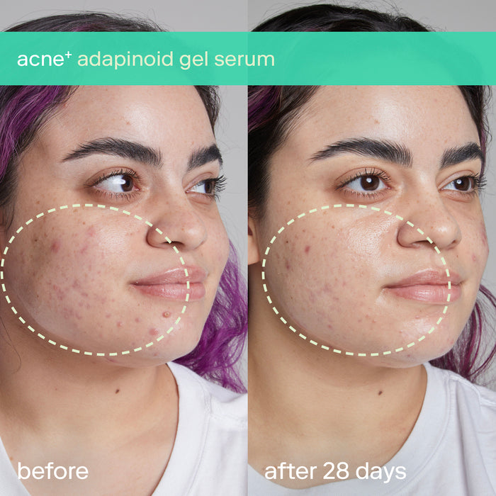 skinfix | acne+ adapinoid Gel with Niacinamide + Squalane