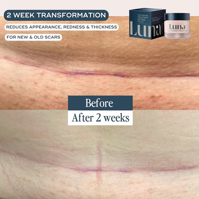 Luna Daily | The Repair Treatment – For Scars & Hyperpigmentation - Best For Acne and Post-Surgery - Silicone Free