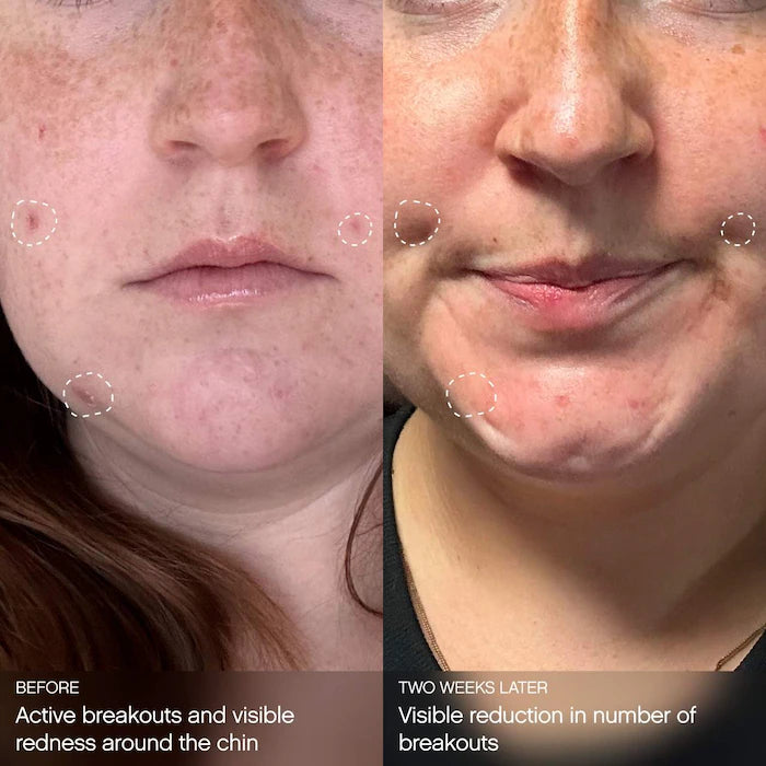 Topicals | Clearly Clarifying & Calming Mask For Breakout-Prone Skin