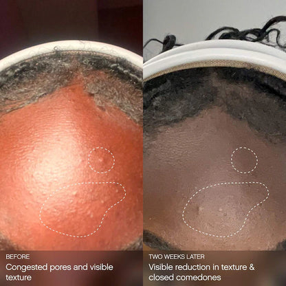 Topicals |  Clearly Clarifying & Calming Mist For Acne-Prone Skin