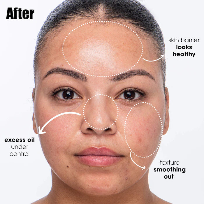 Sunday Riley | Breakout Breakup Salicylic Acid Cleanser for Blemish-Prone Skin