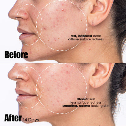 Sunday Riley | Peacekeeper Azaleic and Salicylic Acid Acne Treatment Serum