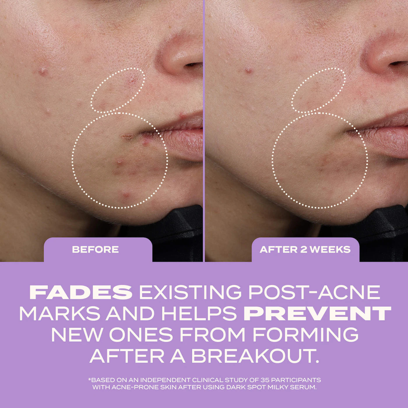 banu | Dark Spot Milky Serum for Brightening, Post-Acne Marks, and Hyperpigmentation