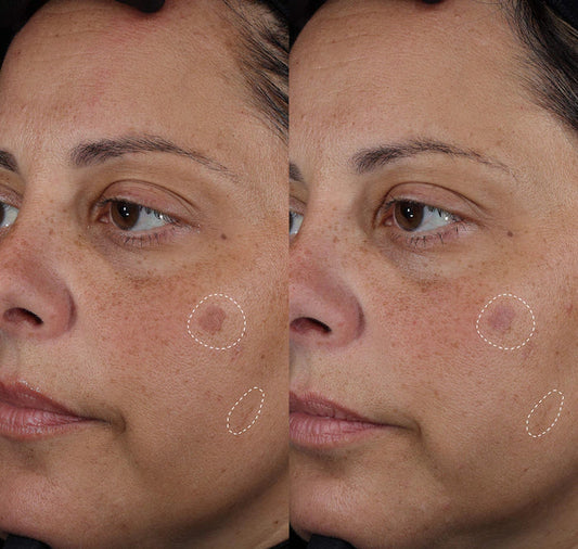 Topicals | Faded Tranexamic Acid Dark Spot Patches for Hyperpigmentation